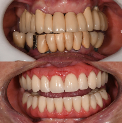 implantes dentarios